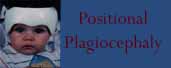 Positional Plagiocephaly.